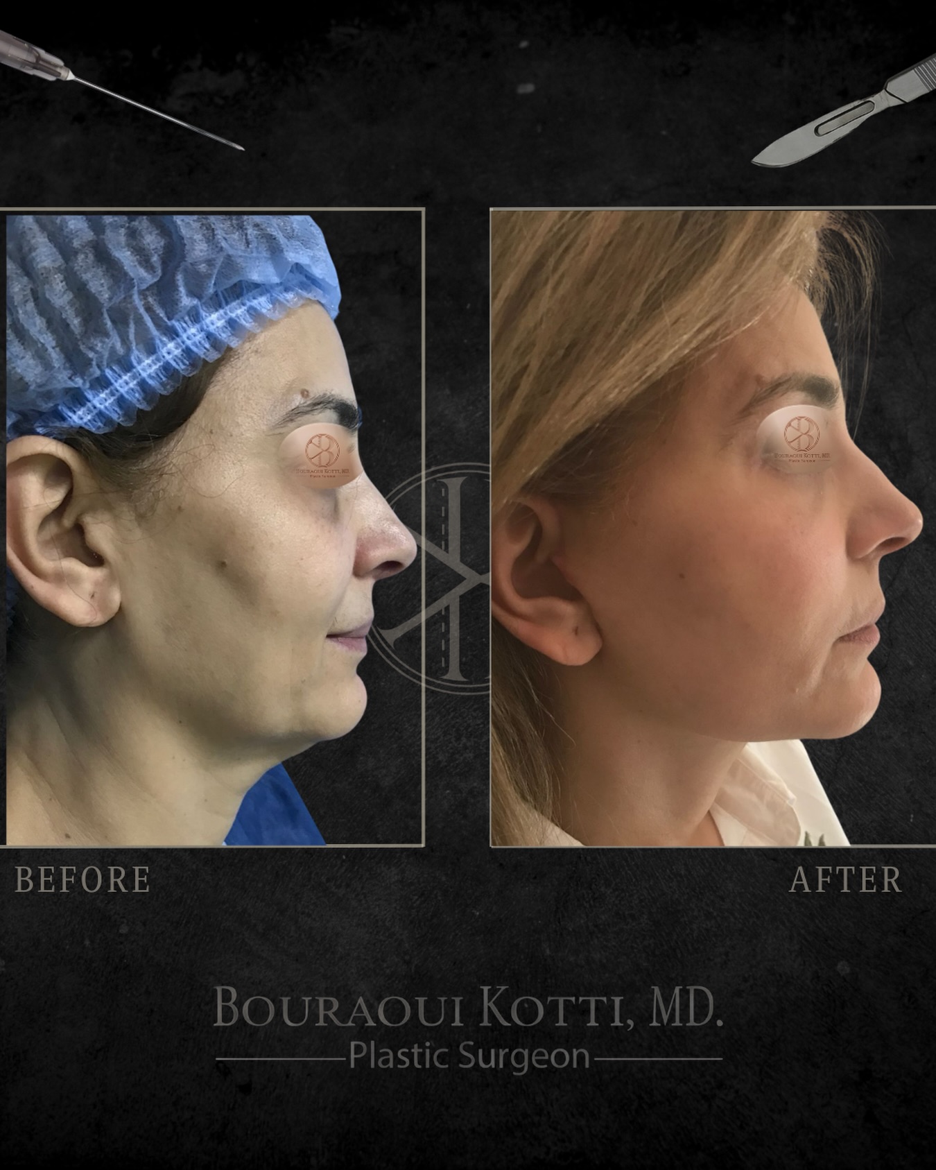 عملية شد الوجه before and after clinical result