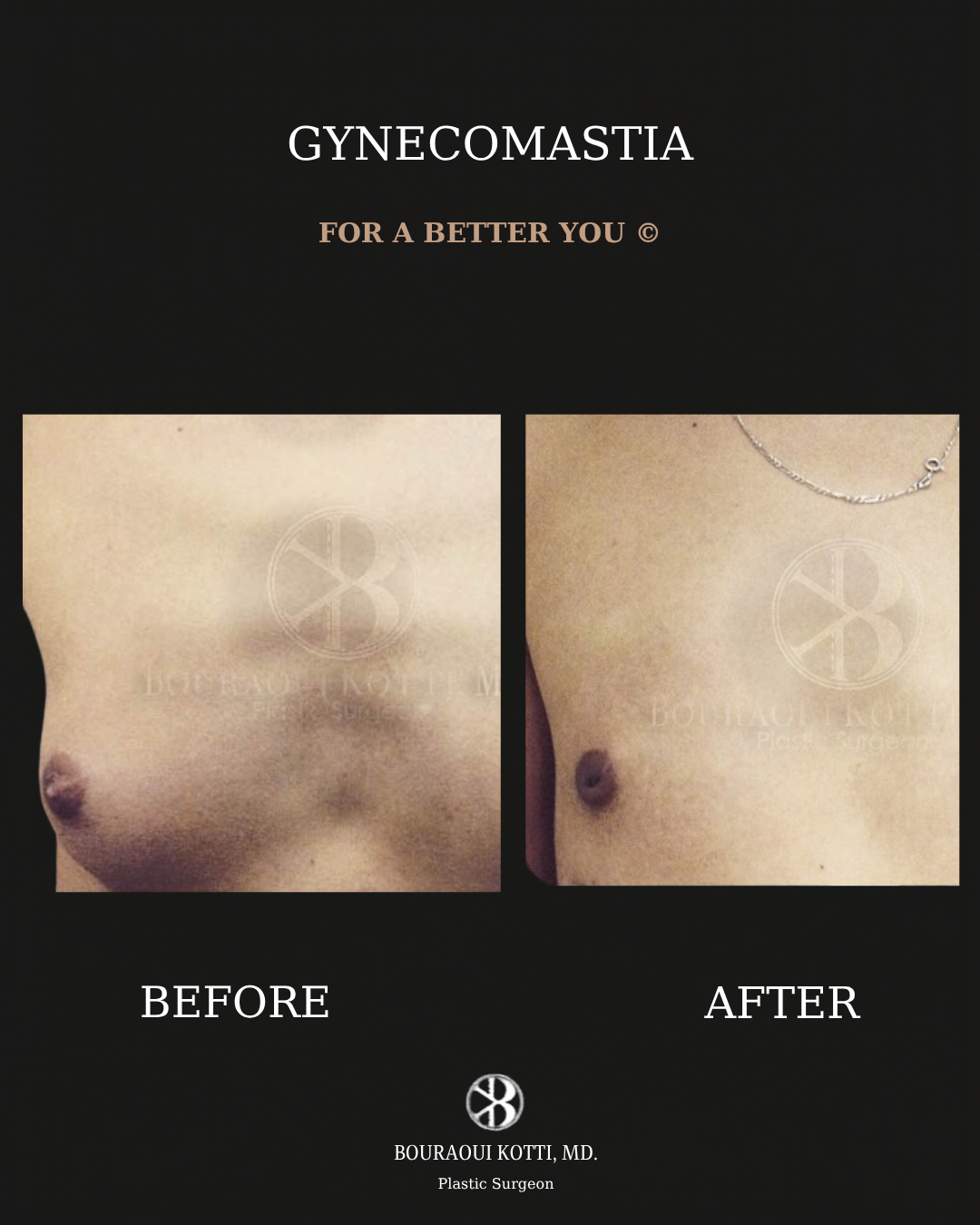 Gynecomastia in Dubai before and after clinical result
