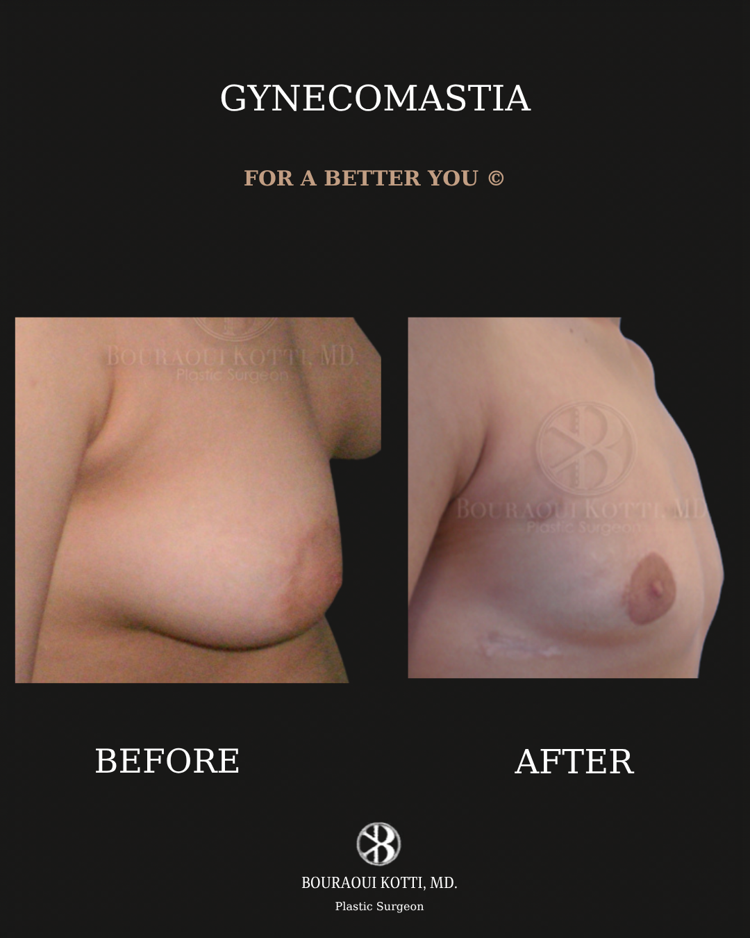 Gynecomastia in Dubai before and after clinical result