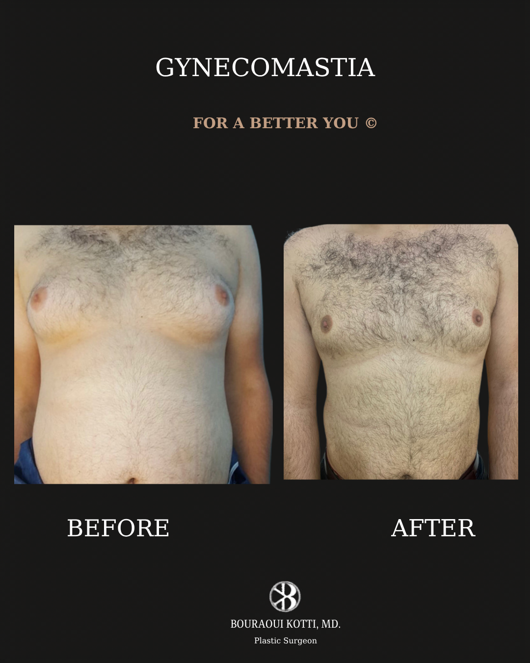 Gynecomastia in Dubai before and after clinical result