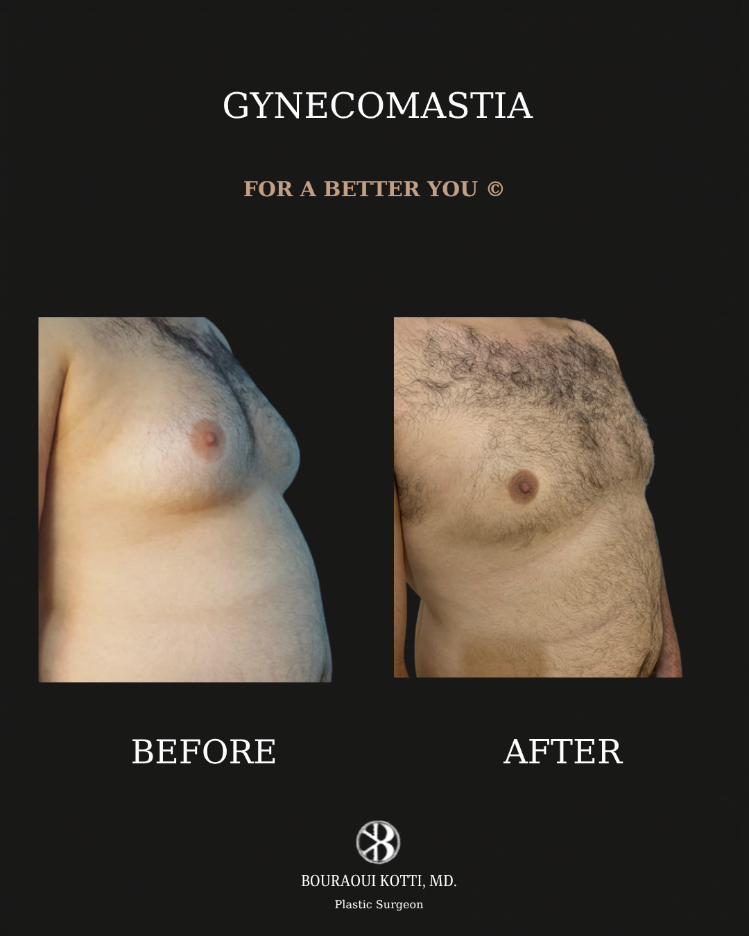 Gynecomastia in Dubai before and after clinical result