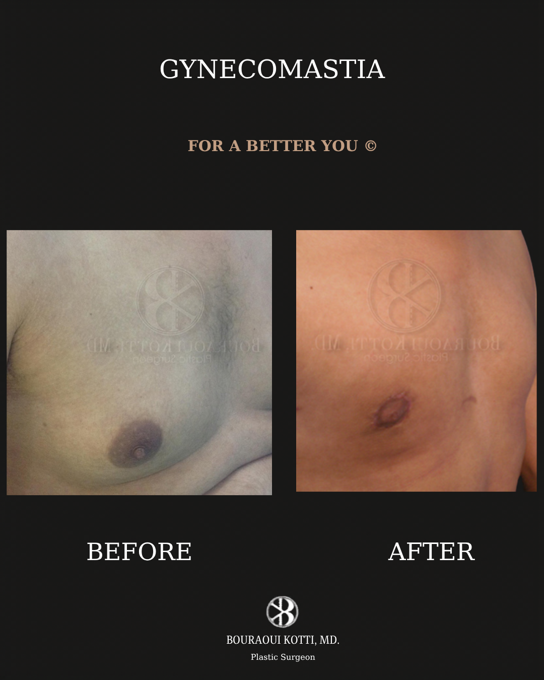 Gynecomastia in Dubai before and after clinical result