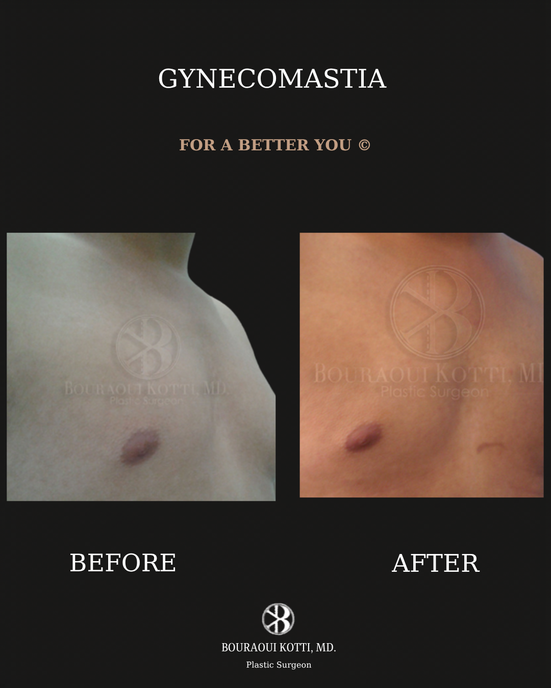 Gynecomastia in Dubai before and after clinical result