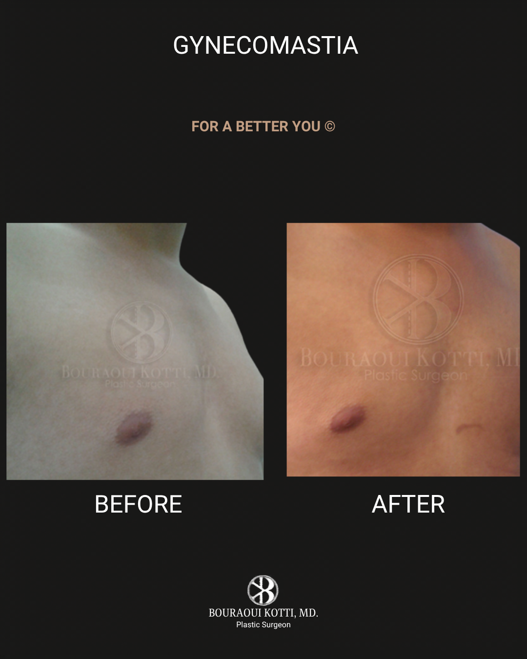 Gynecomastia in Dubai before and after clinical result