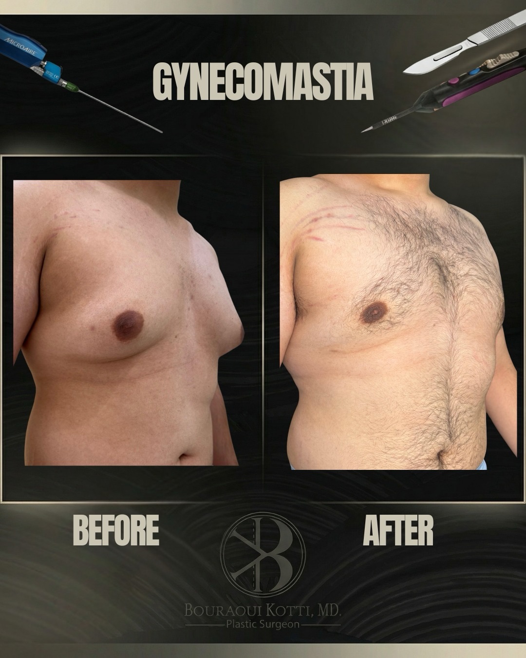 Gynecomastia in Dubai before and after clinical result
