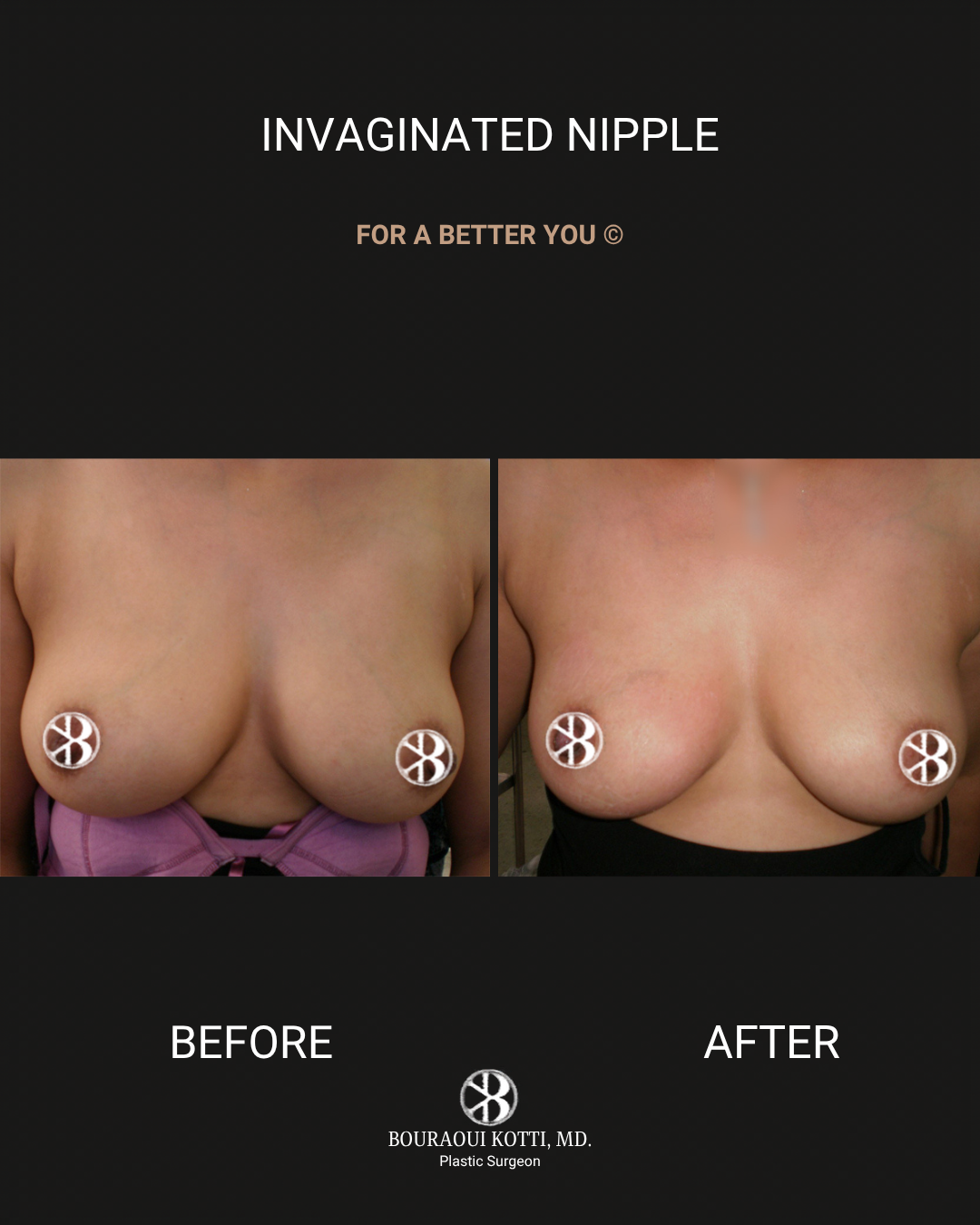 Nipple Inversion Correction Surgery in Dubai before and after clinical result