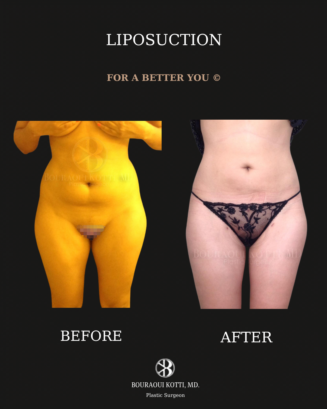 Liposuction before and after clinical result