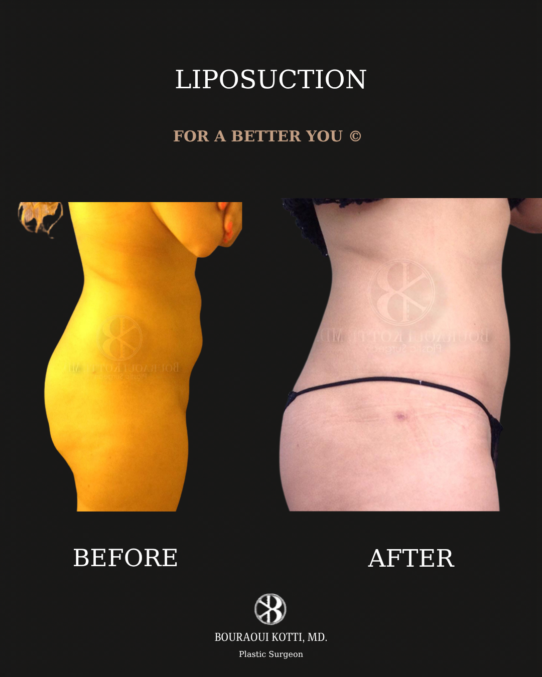 Liposuction before and after clinical result