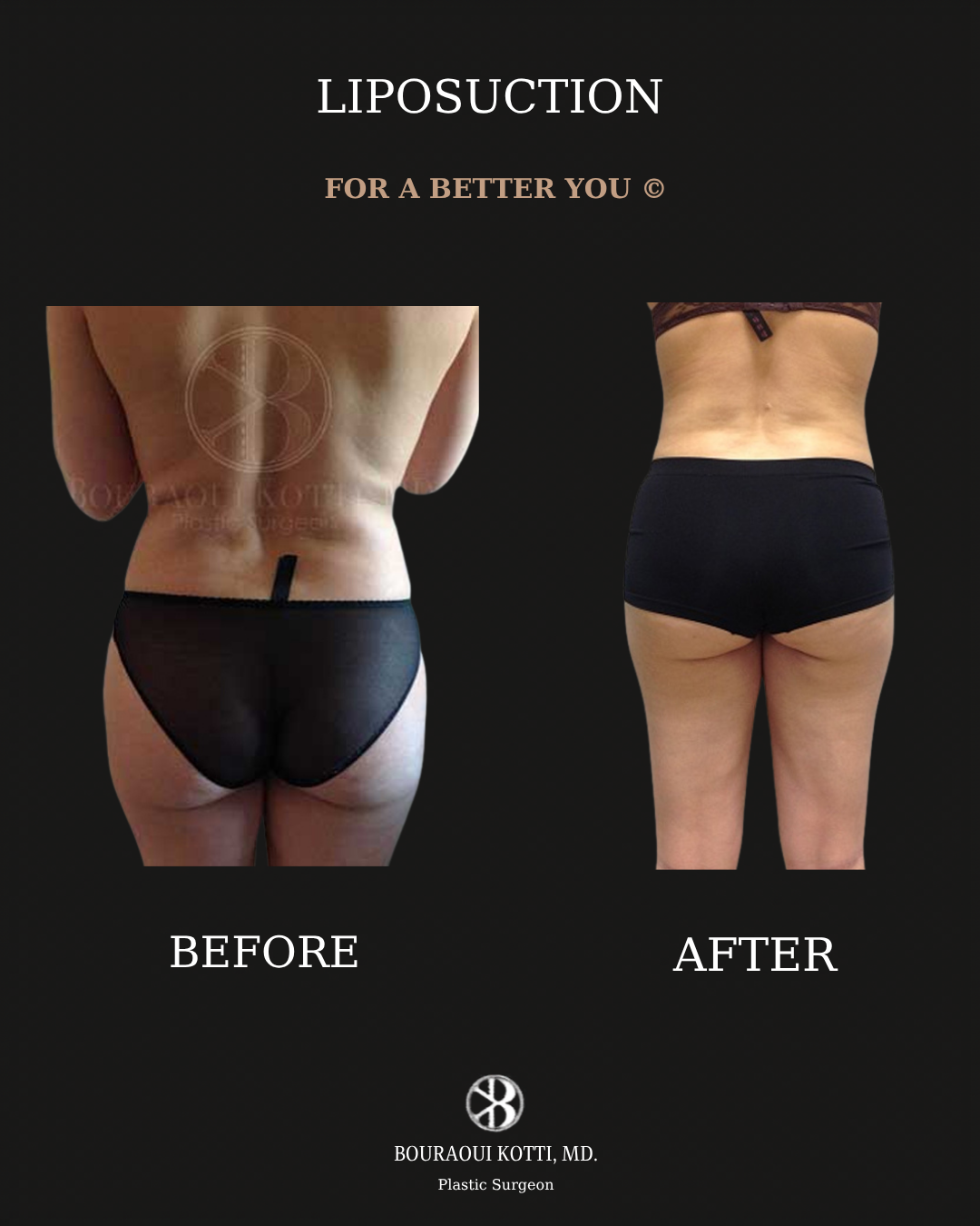 Liposuction before and after clinical result