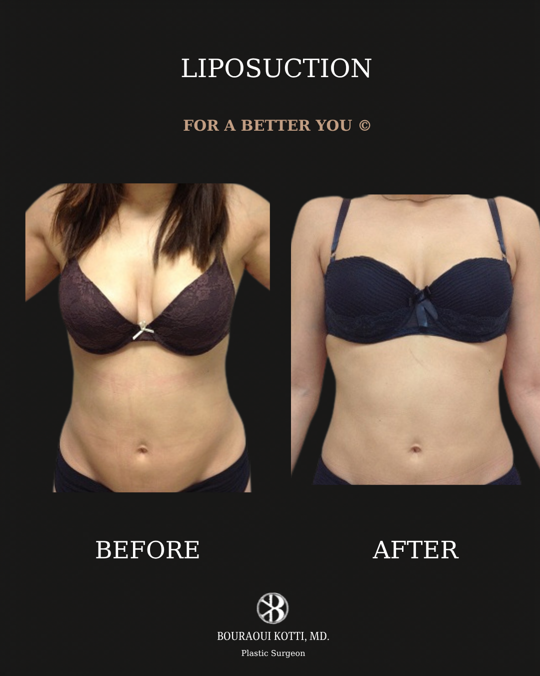Liposuction before and after clinical result