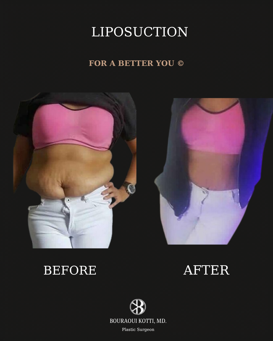 Liposuction before and after clinical result