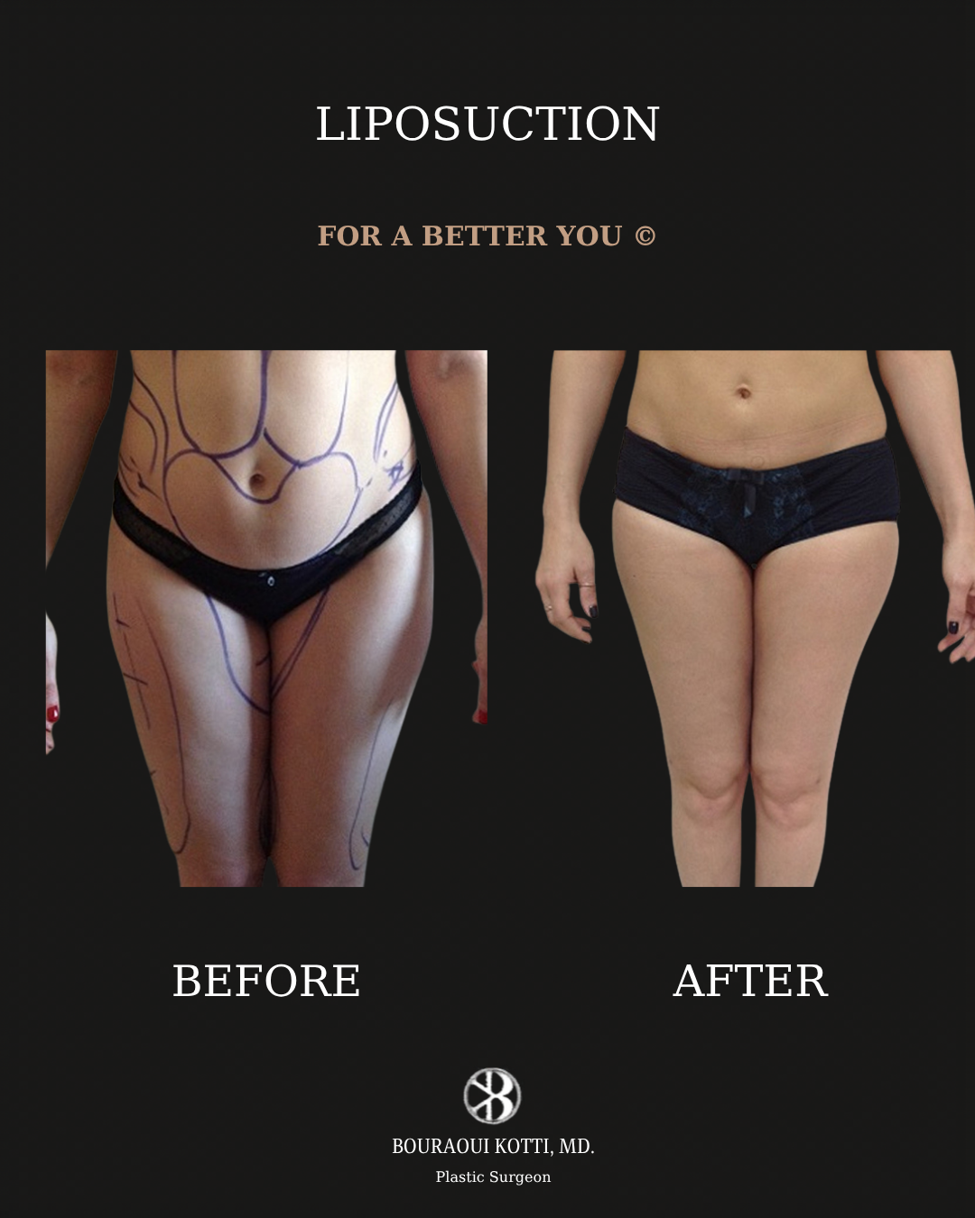 Liposuction before and after clinical result