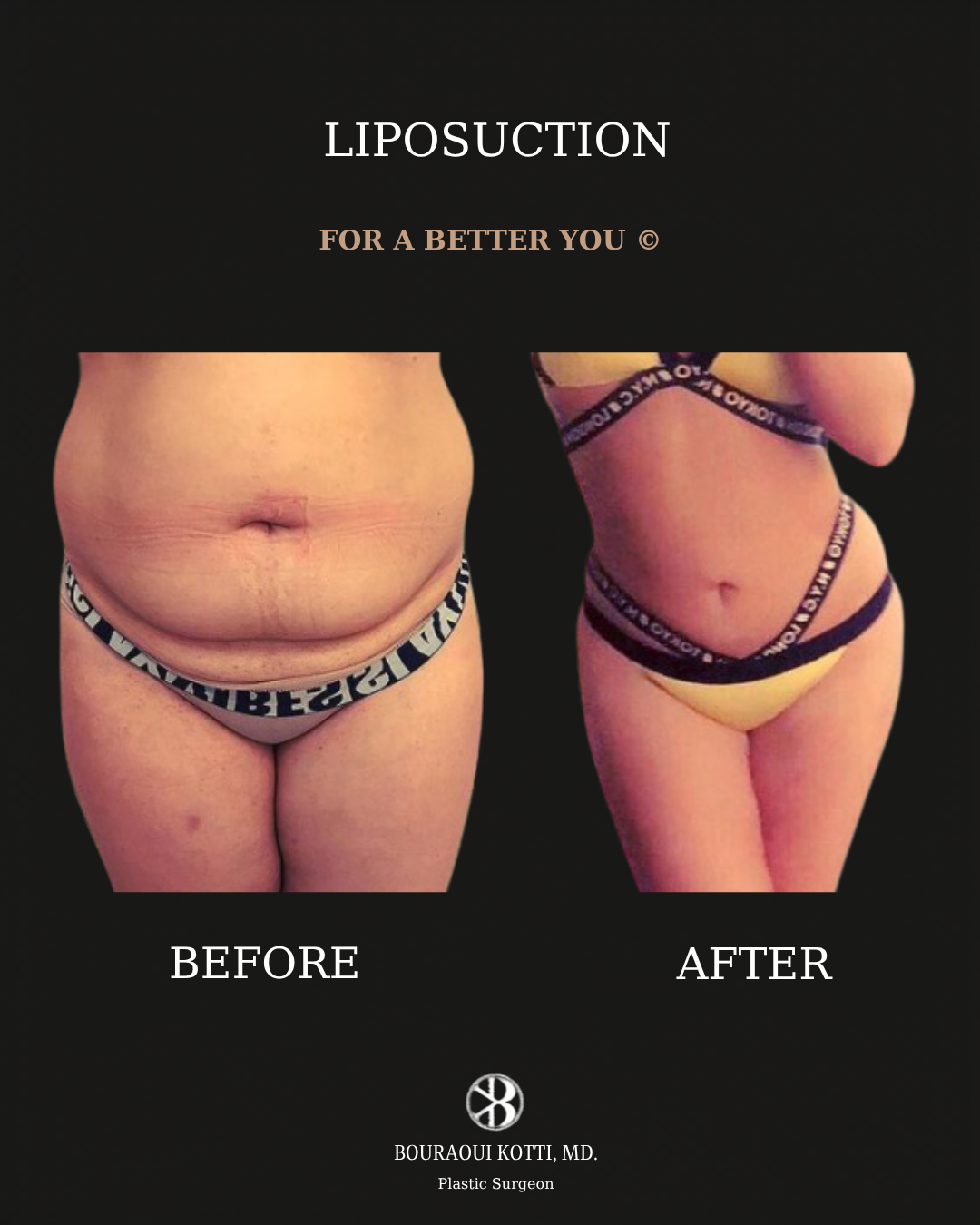 Liposuction before and after clinical result