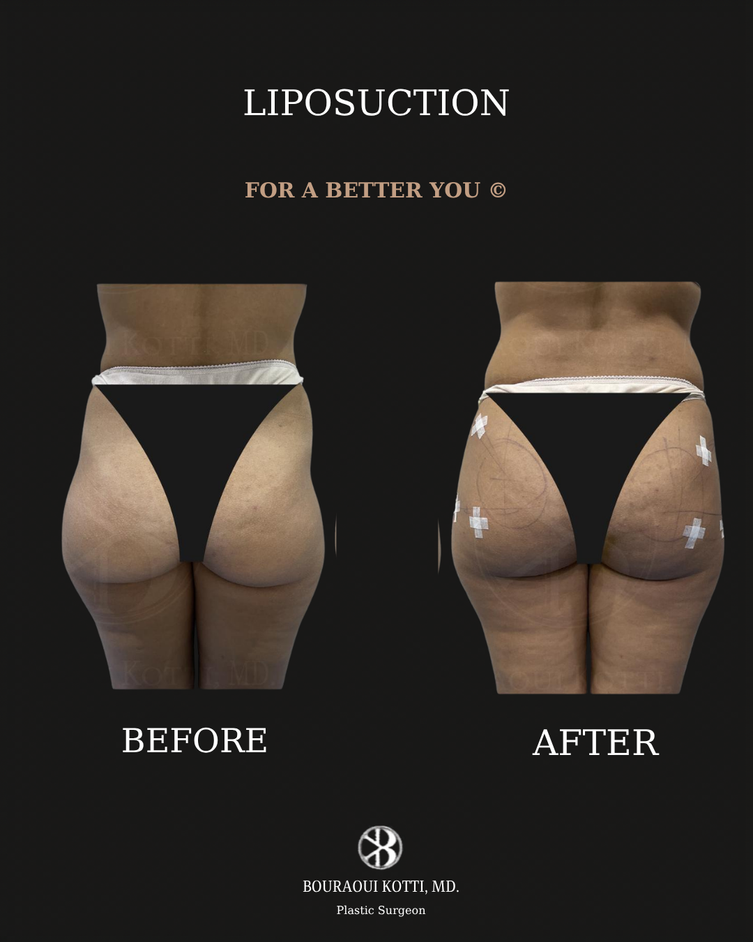 Liposuction before and after clinical result