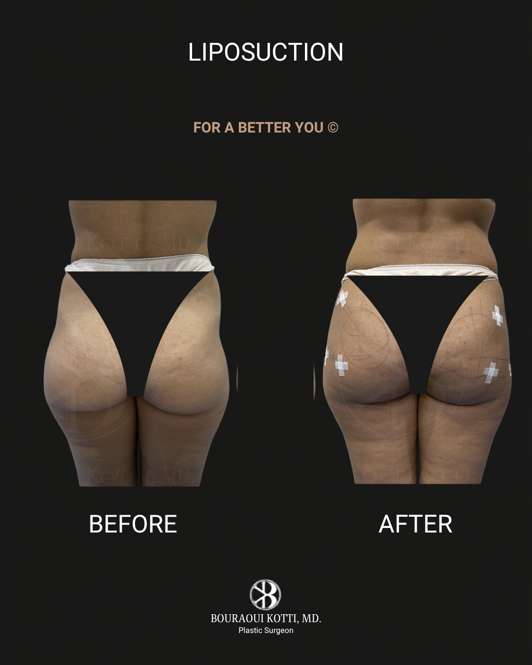 Liposuction before and after clinical result