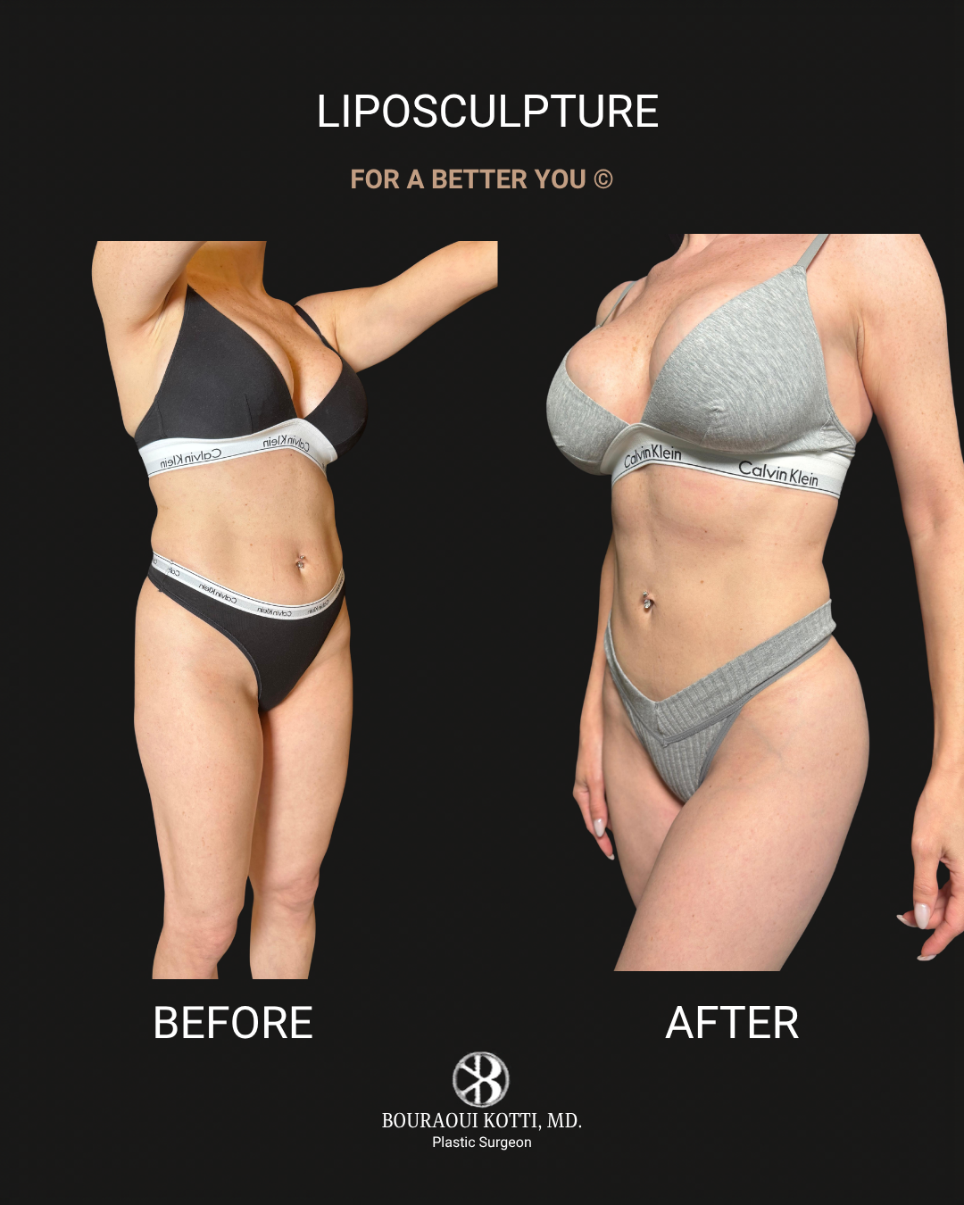 Liposuction before and after clinical result
