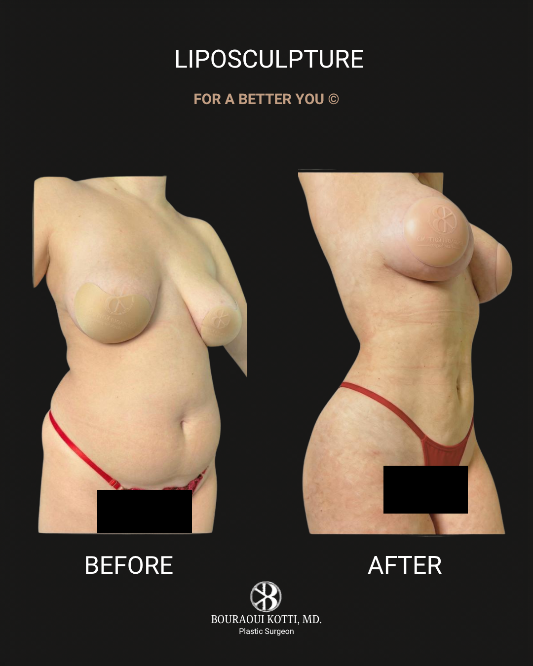 Liposuction before and after clinical result