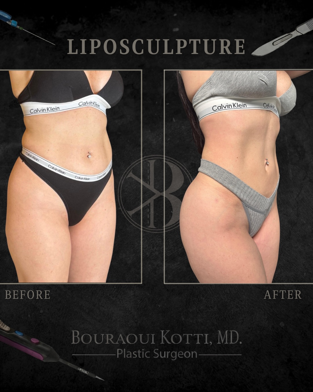 Liposuction before and after clinical result