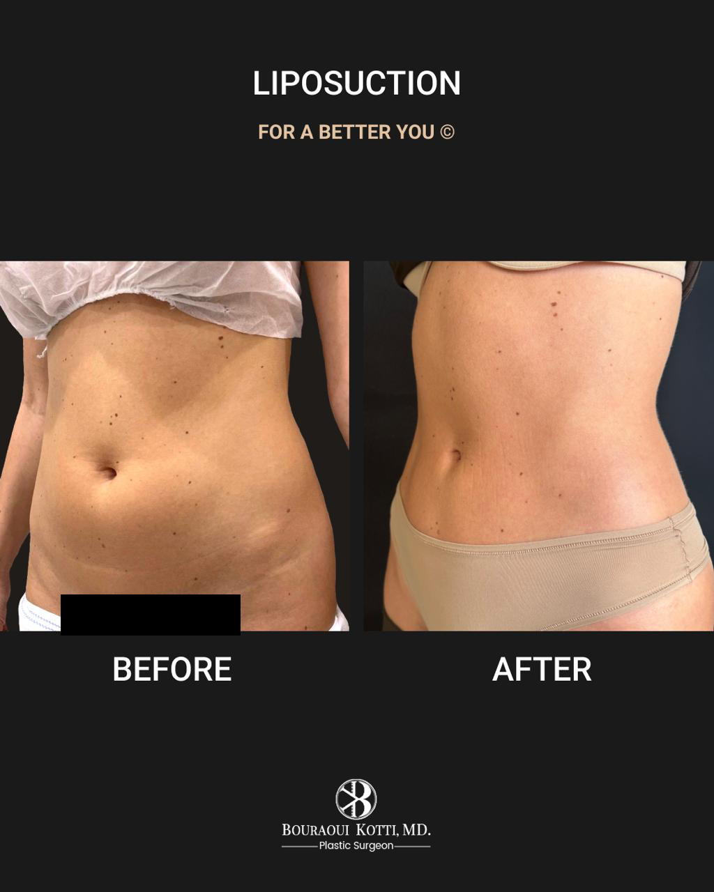 Liposuction before and after clinical result