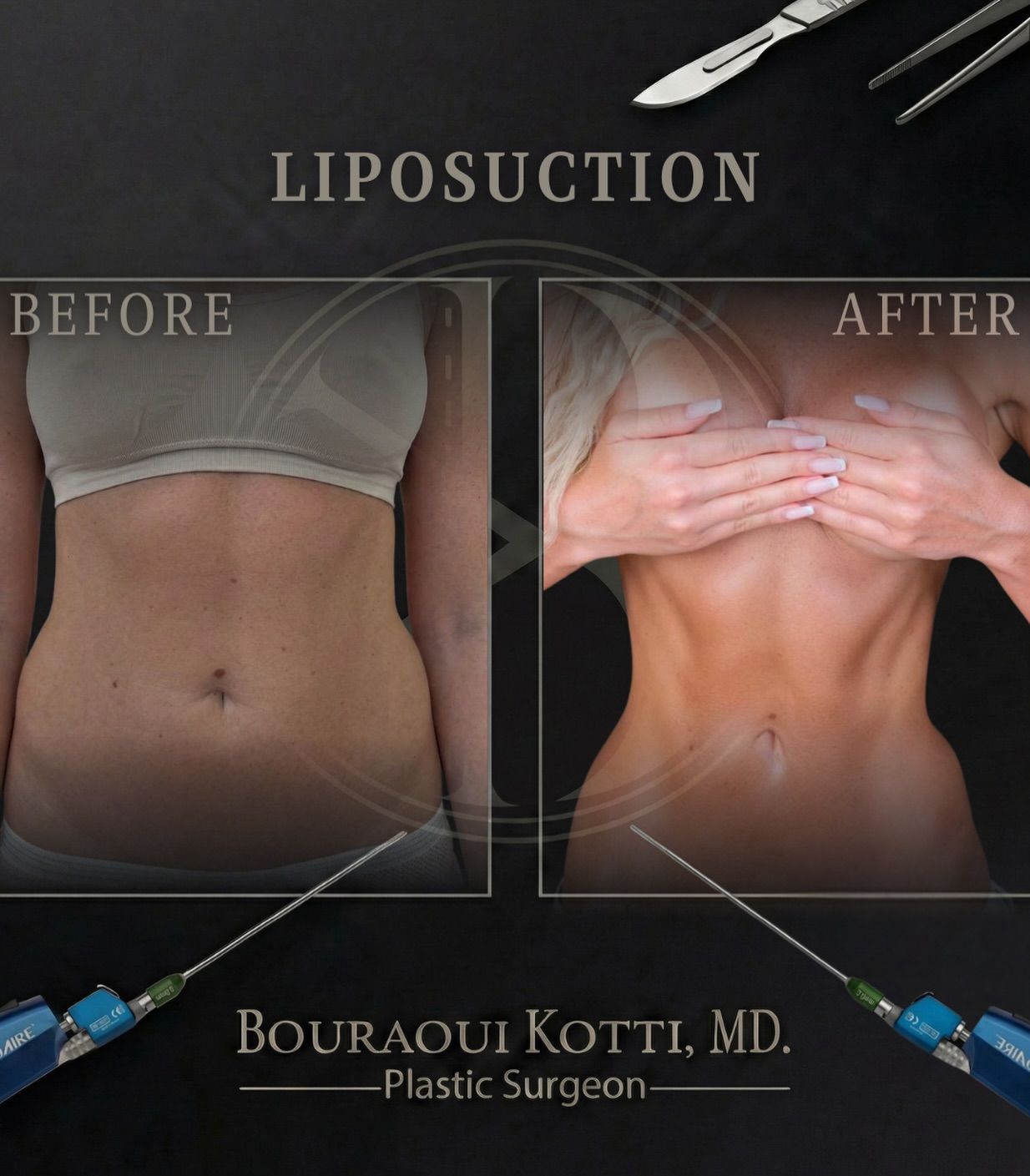 Liposuction before and after clinical result