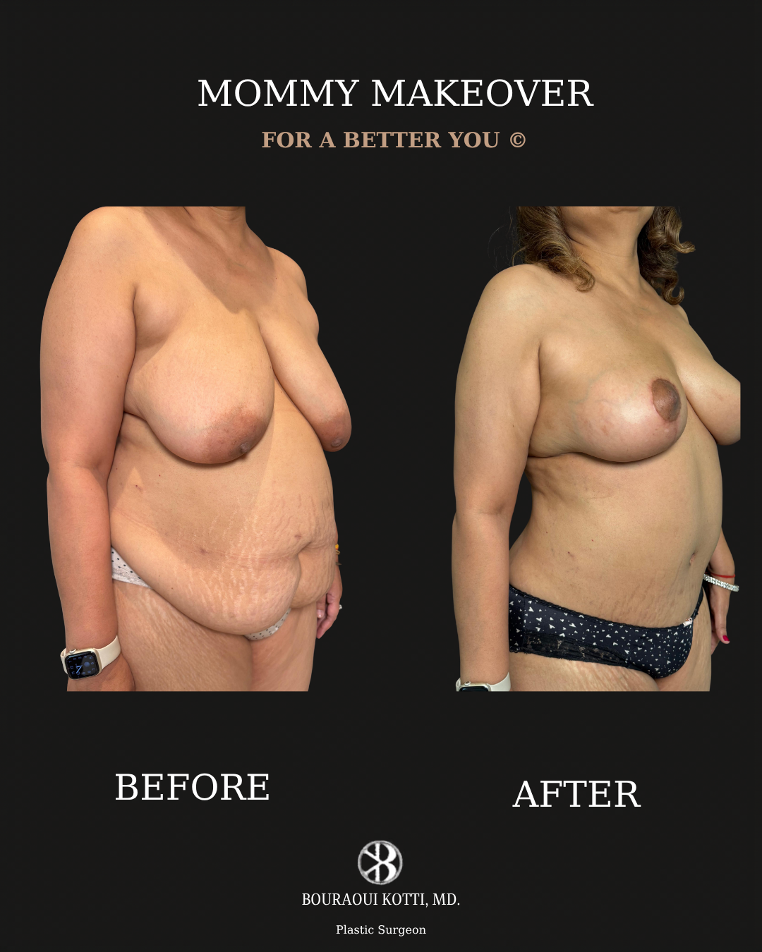 Mommy Makeover in Dubai before and after clinical result