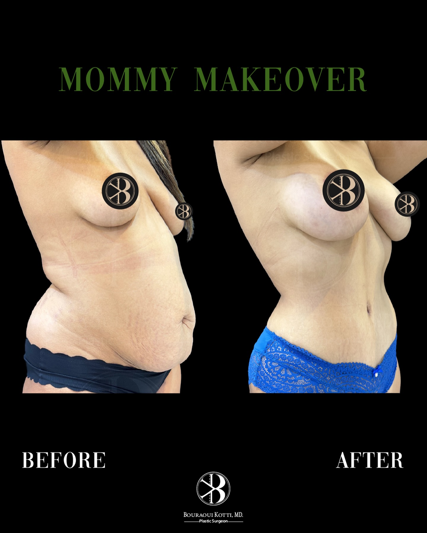 Mommy Makeover in Dubai before and after clinical result