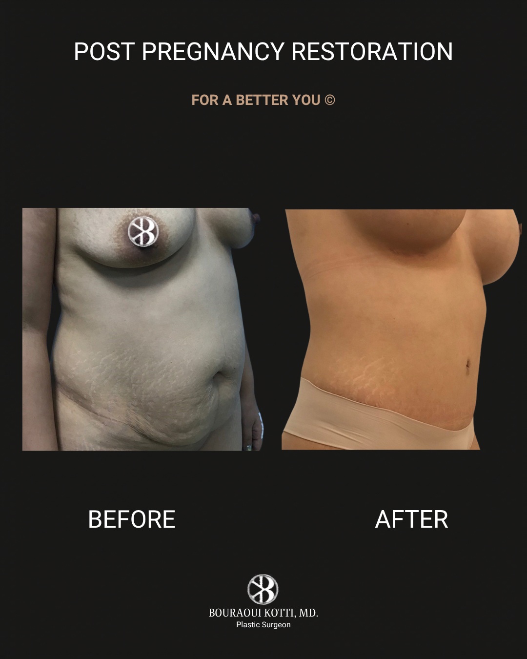 Mommy Makeover in Dubai before and after clinical result