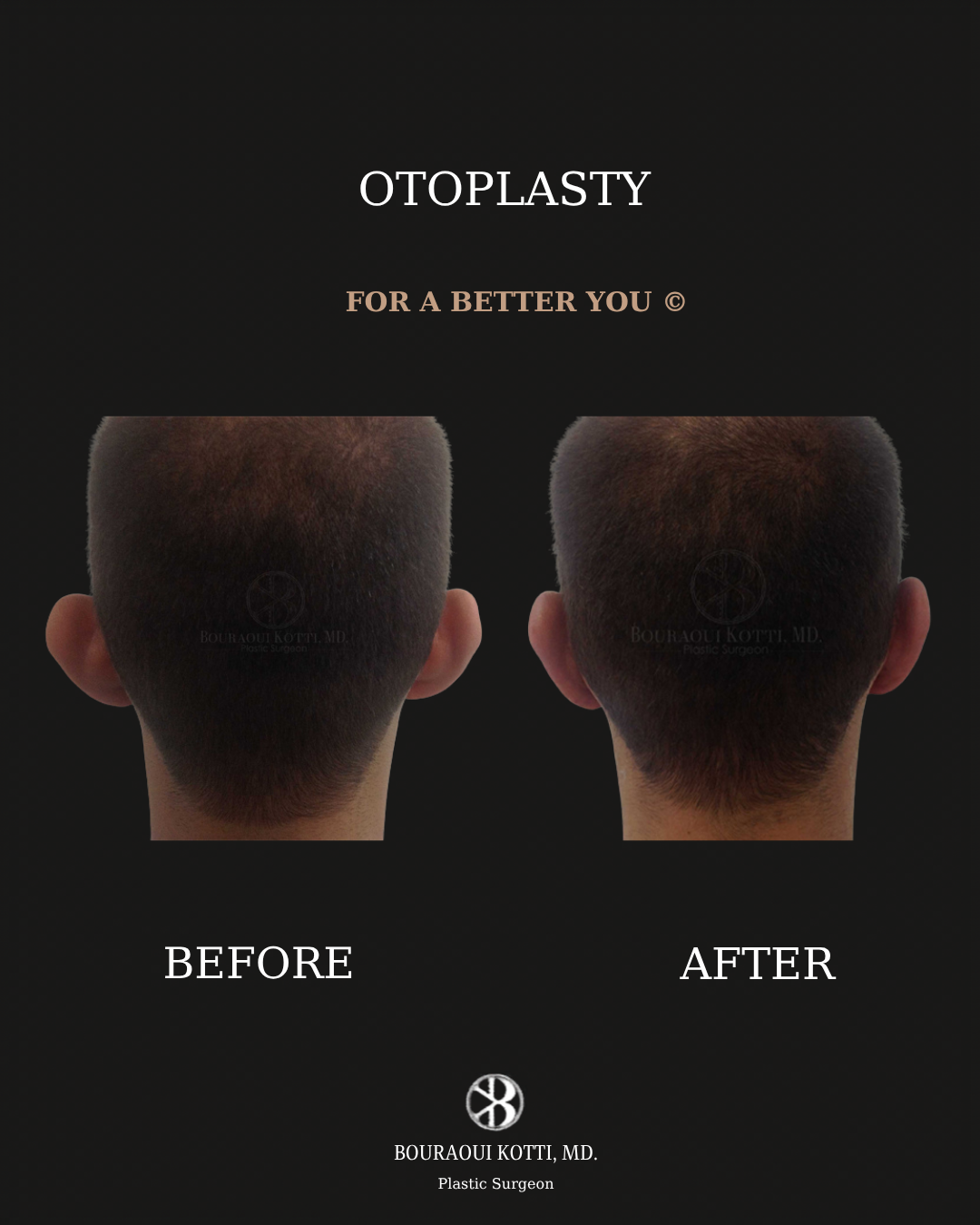 Otoplasty (Ear Reshaping and Pinning Surgery) before and after clinical result