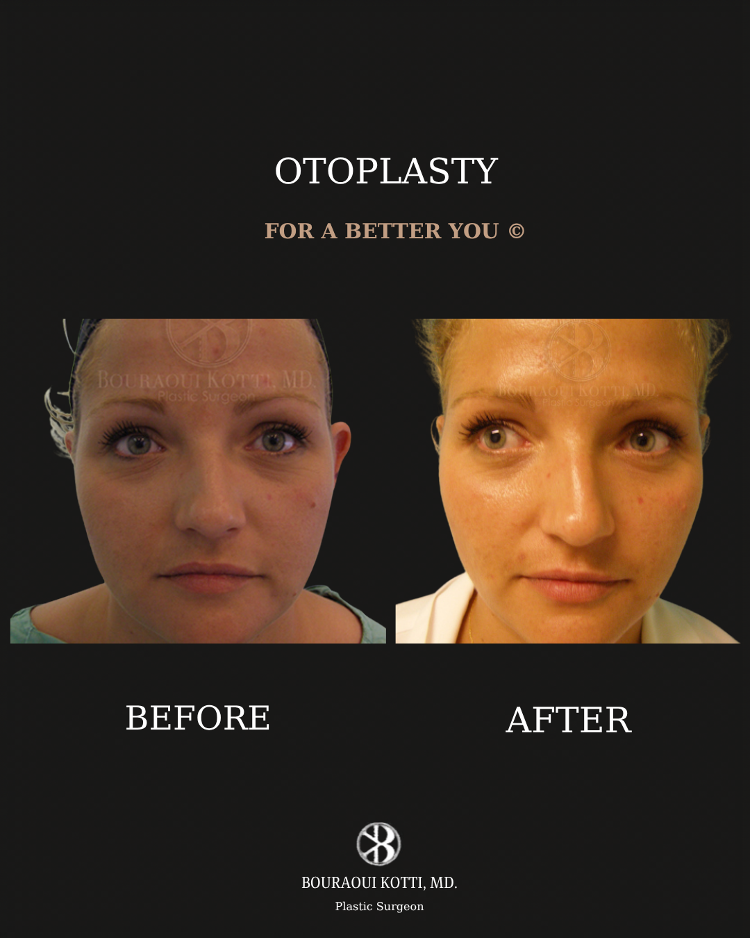 Otoplasty (Ear Reshaping and Pinning Surgery) before and after clinical result