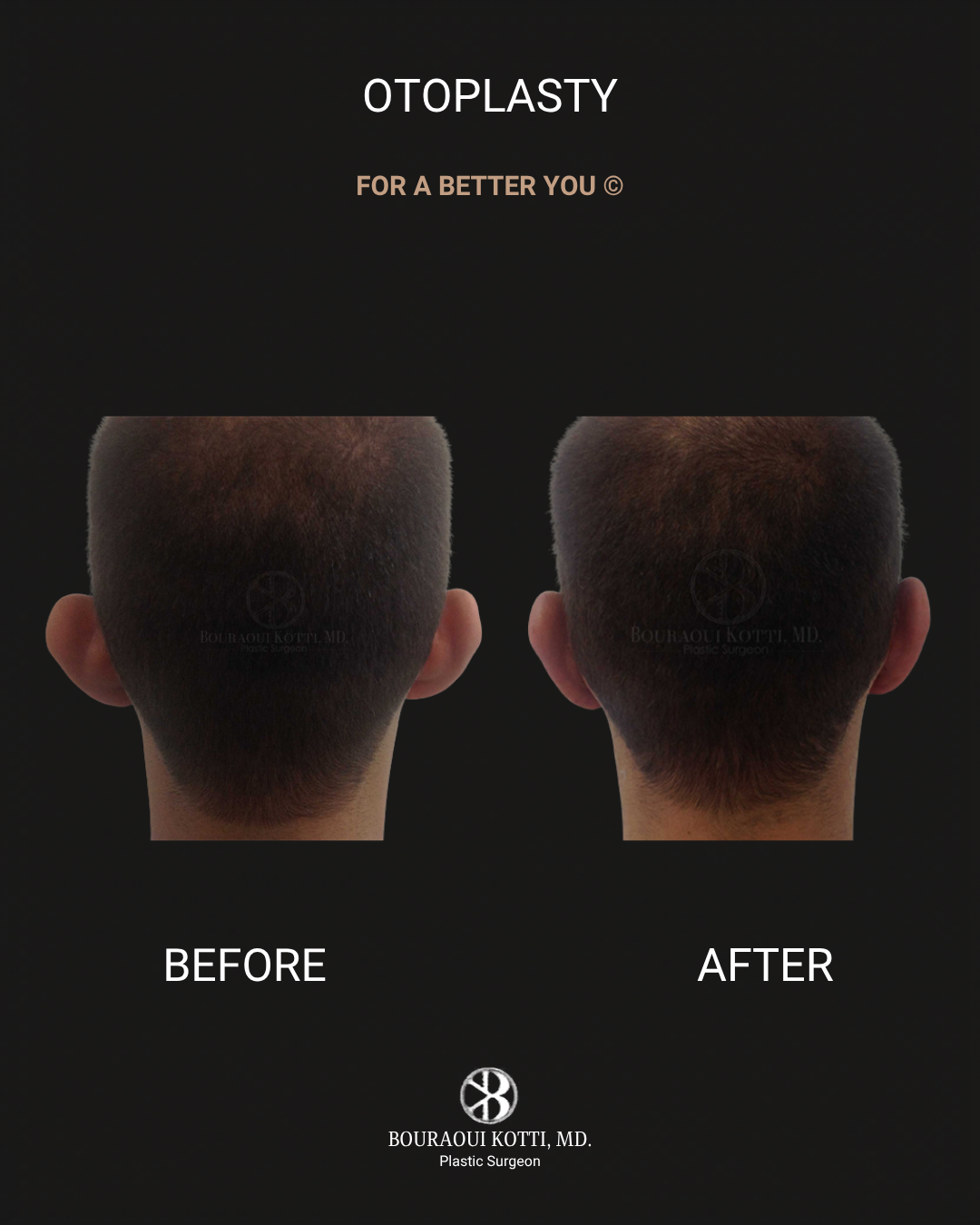 Otoplasty (Ear Reshaping and Pinning Surgery) before and after clinical result