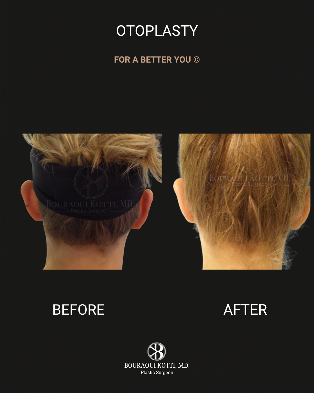 Otoplasty (Ear Reshaping and Pinning Surgery) before and after clinical result