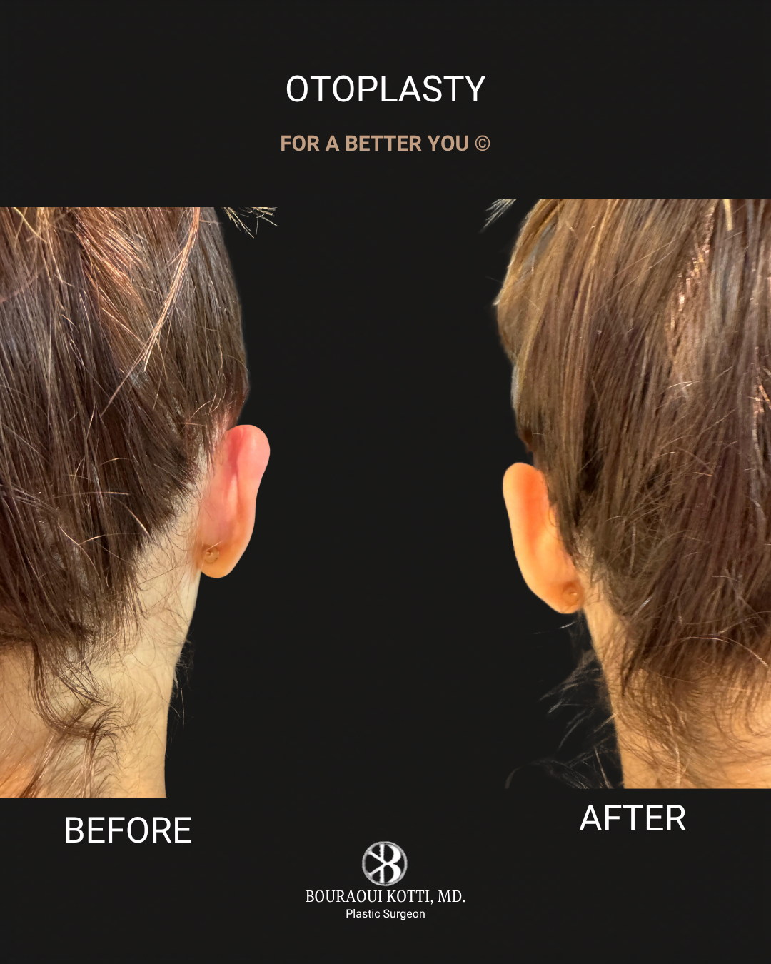 Otoplasty (Ear Reshaping and Pinning Surgery) before and after clinical result