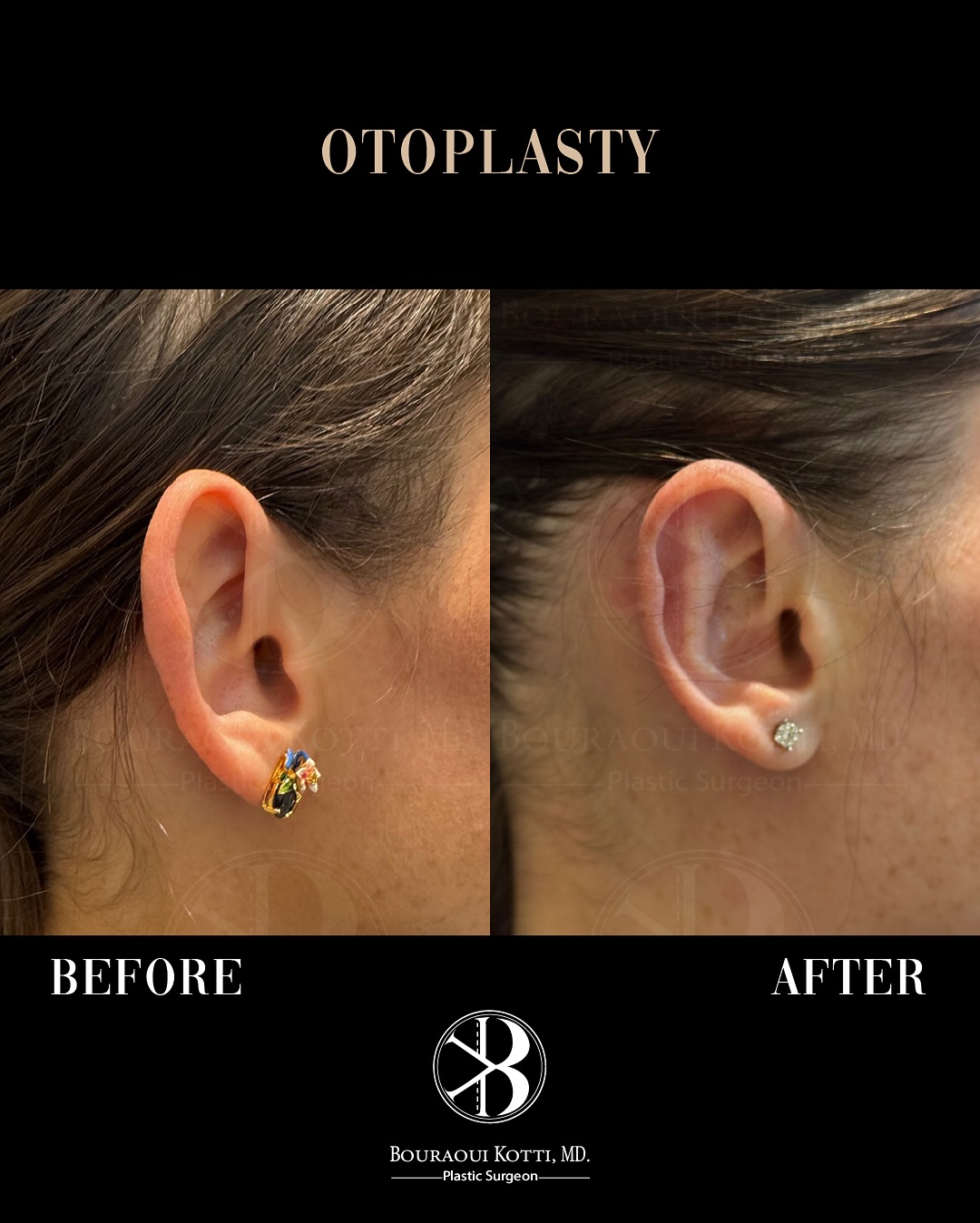 Otoplasty (Ear Reshaping and Pinning Surgery) before and after clinical result