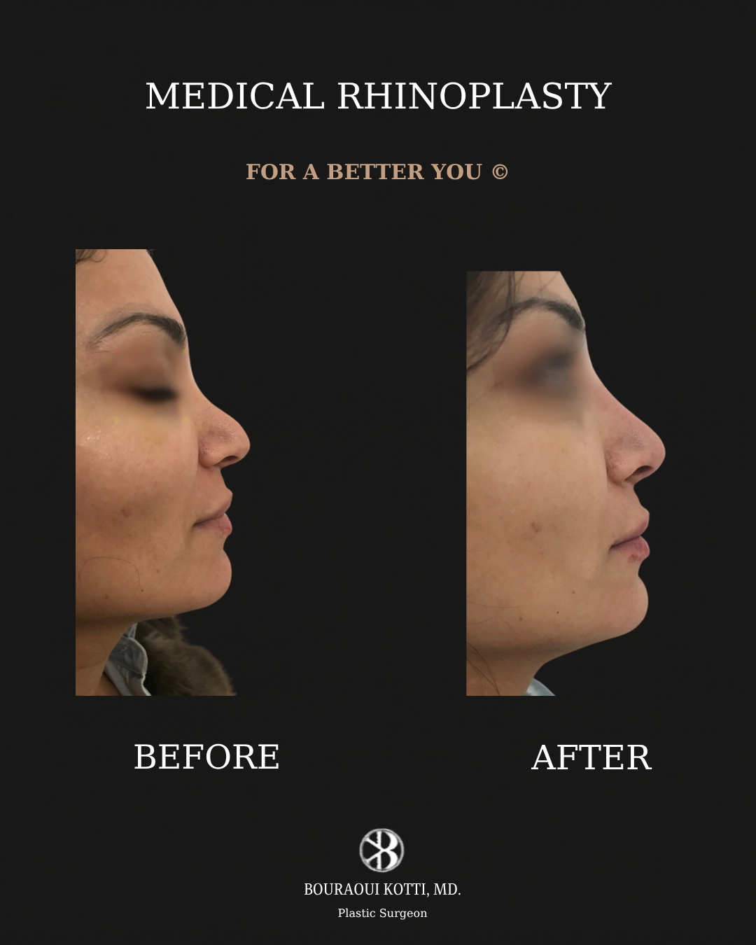 Rhinoplasty before and after clinical result