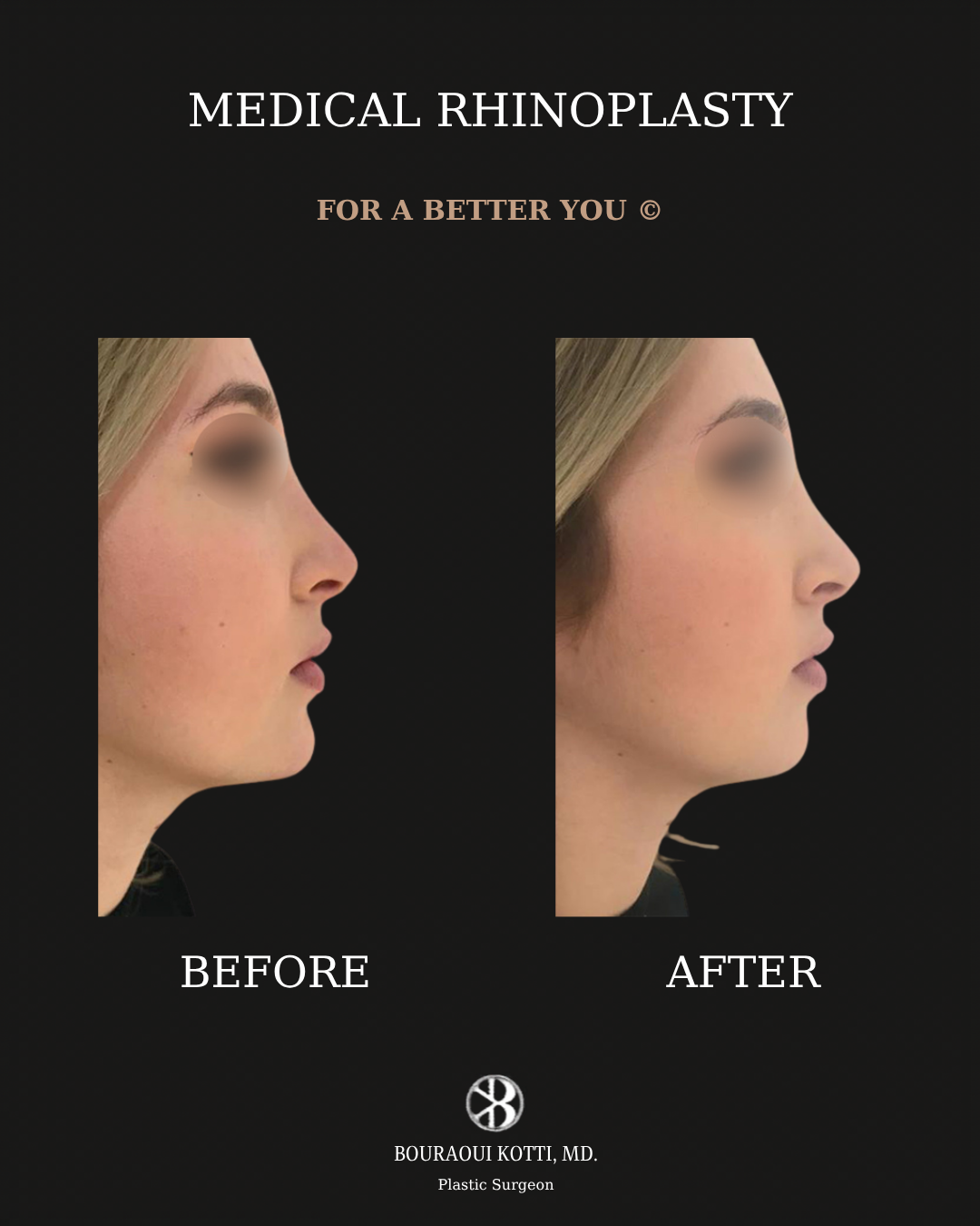Rhinoplasty before and after clinical result