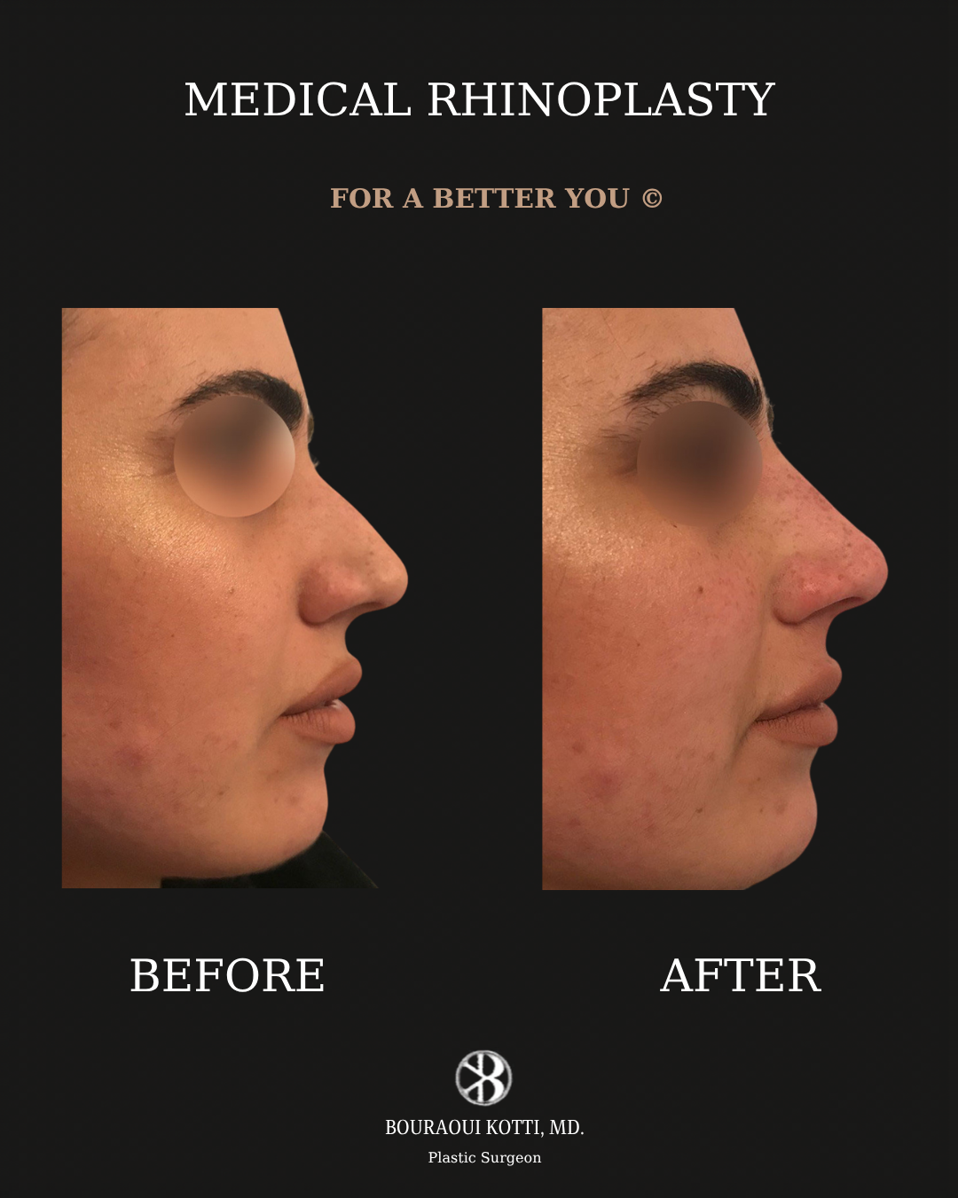 Rhinoplasty before and after clinical result