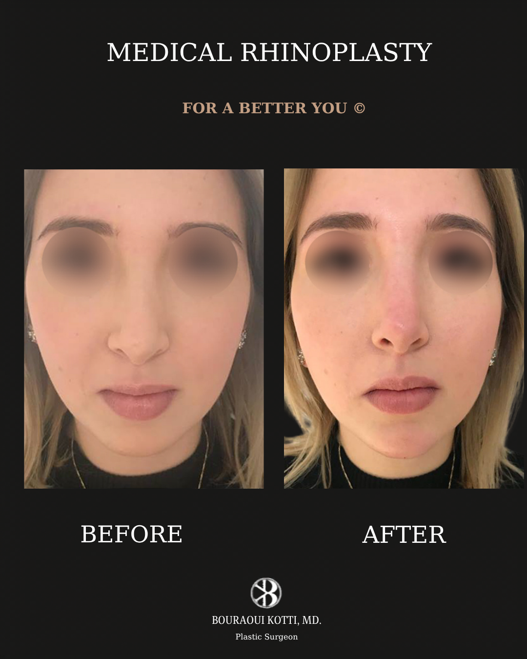 Rhinoplasty before and after clinical result