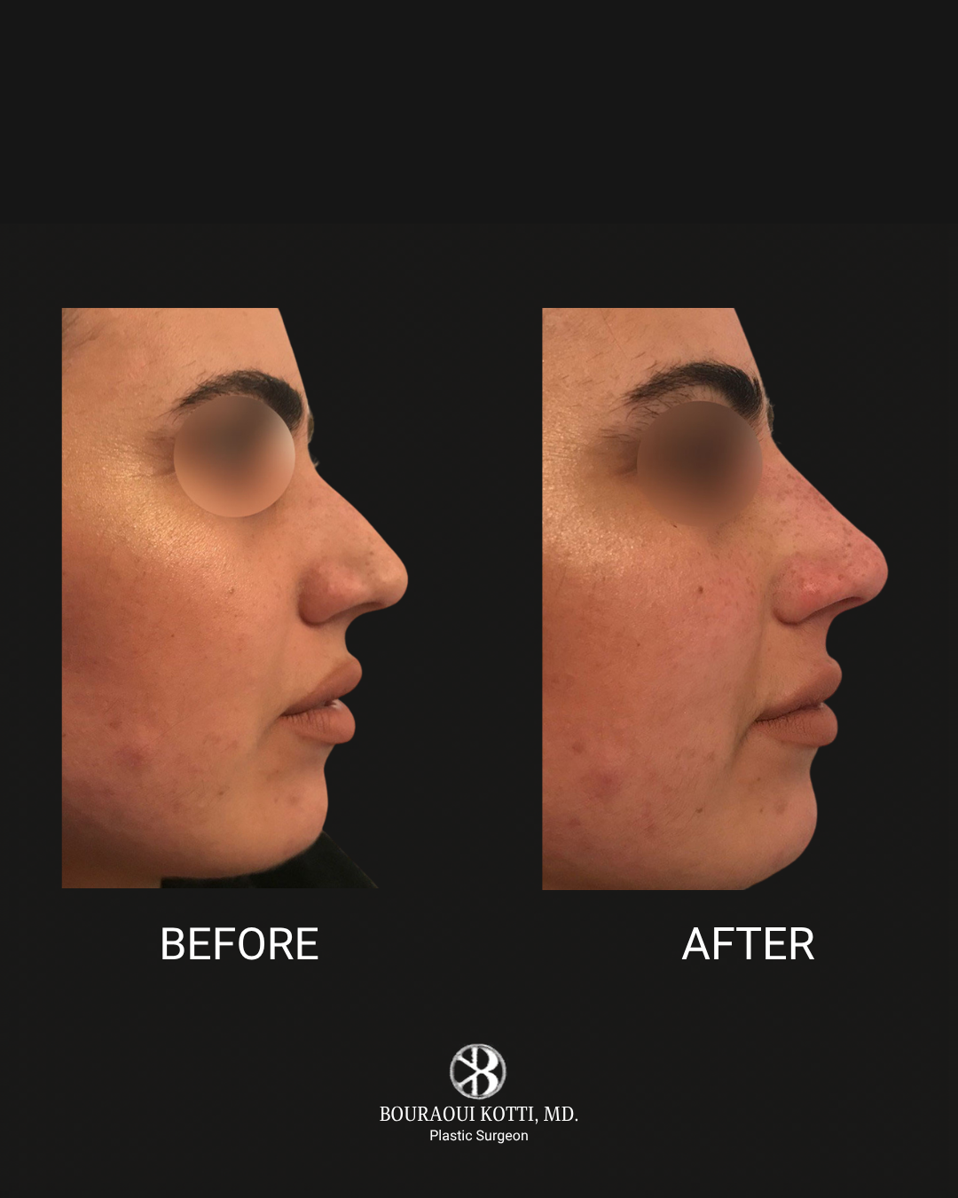 Rhinoplasty before and after clinical result