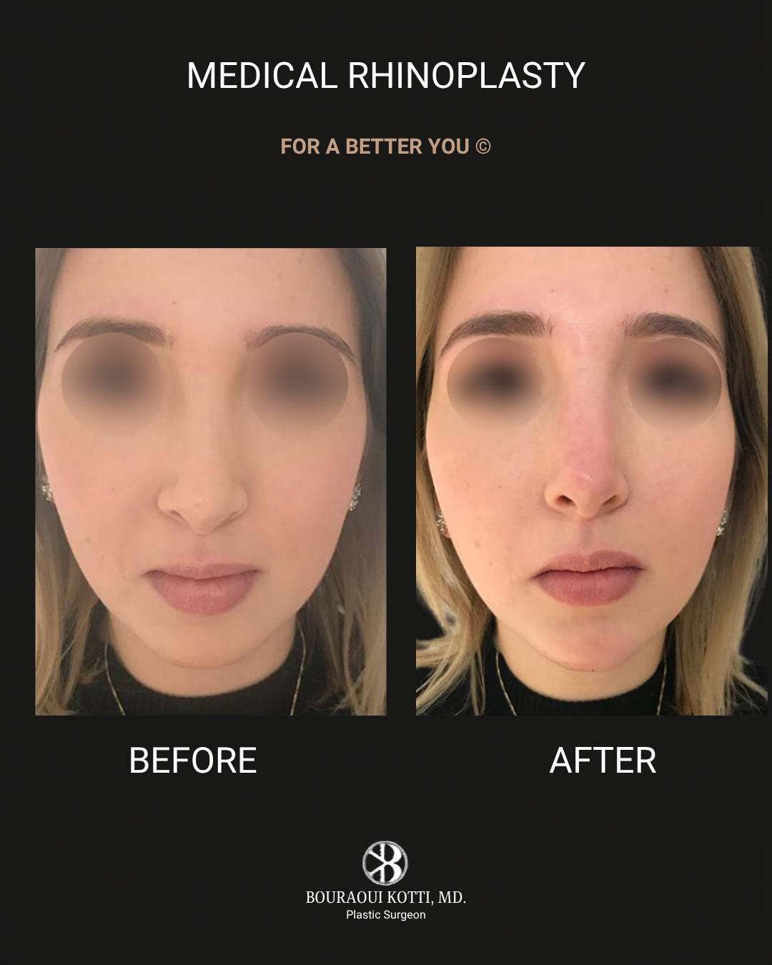 Rhinoplasty before and after clinical result