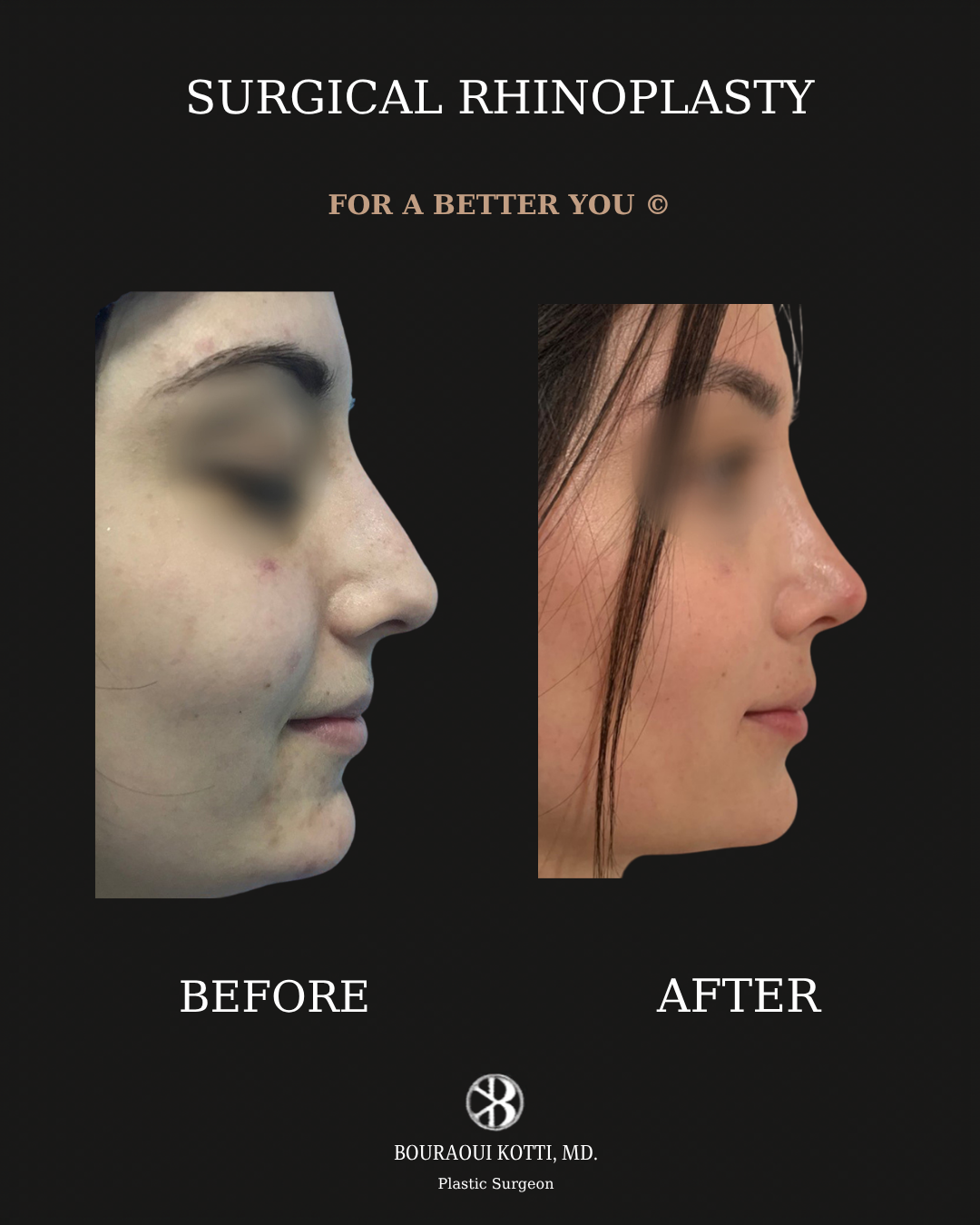 Rhinoplasty before and after clinical result
