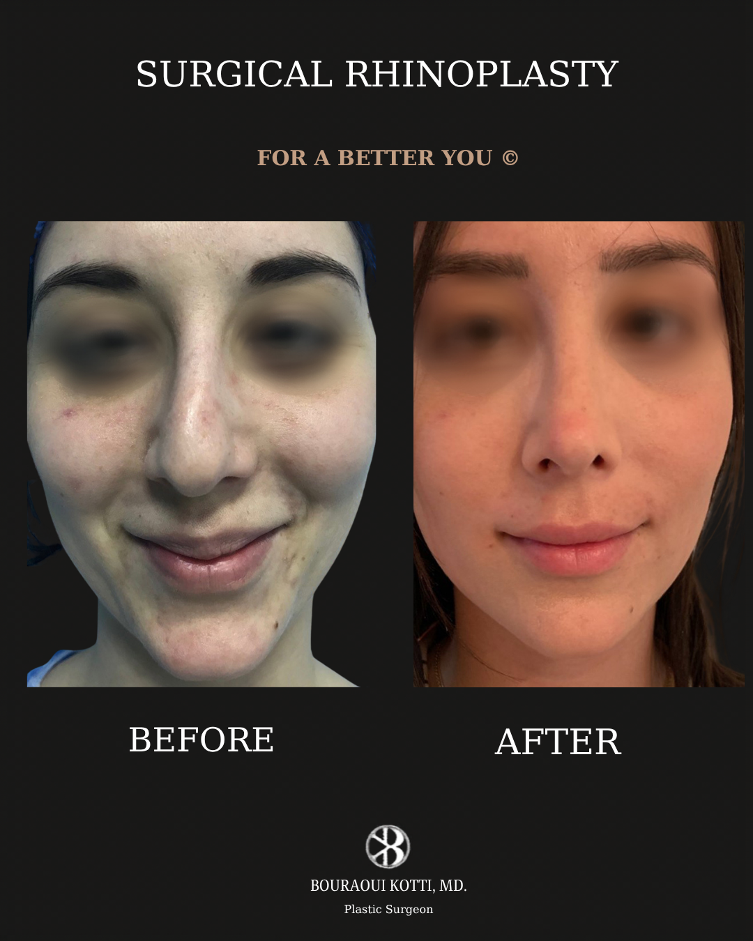 Rhinoplasty before and after clinical result