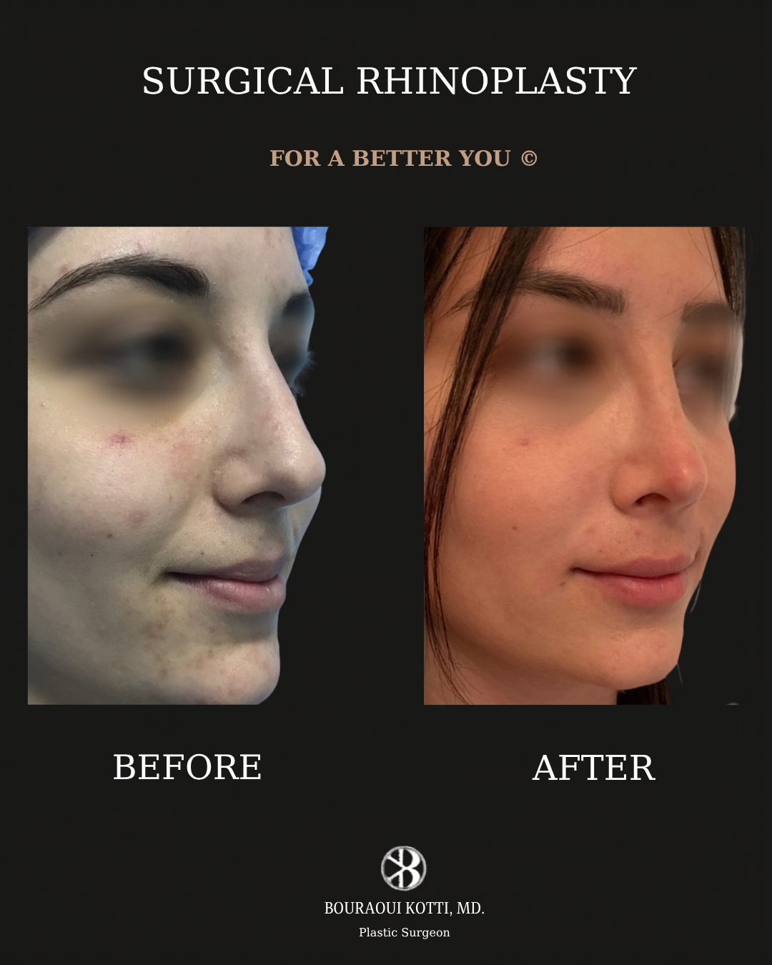 Rhinoplasty before and after clinical result