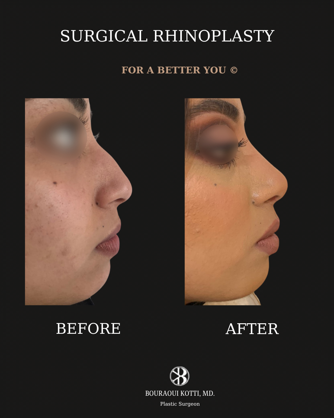 Rhinoplasty before and after clinical result