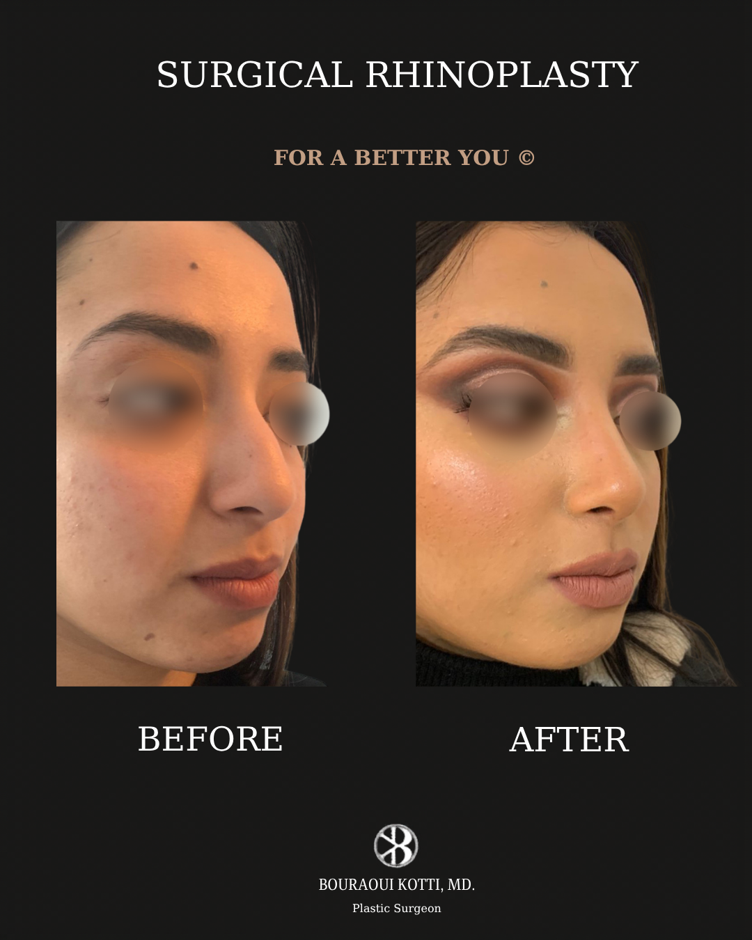 Rhinoplasty before and after clinical result