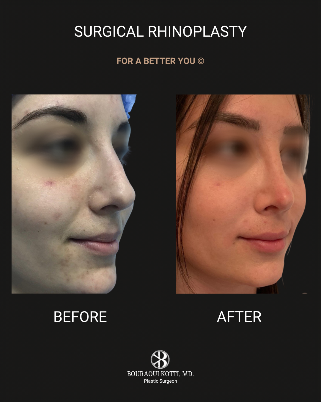 Rhinoplasty before and after clinical result
