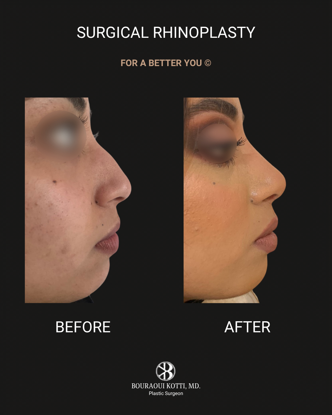 Rhinoplasty before and after clinical result