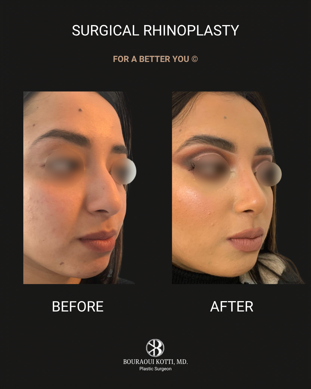 Rhinoplasty before and after clinical result