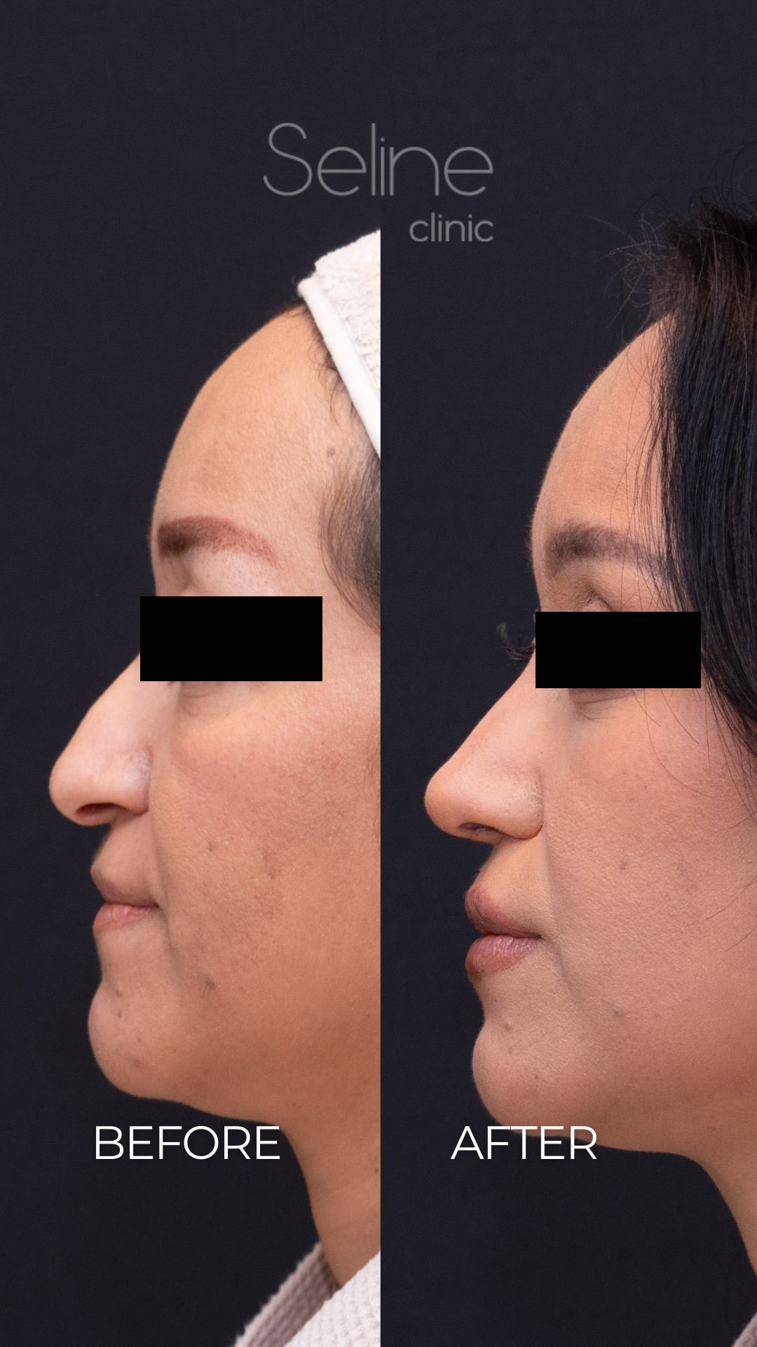 Rhinoplasty before and after clinical result