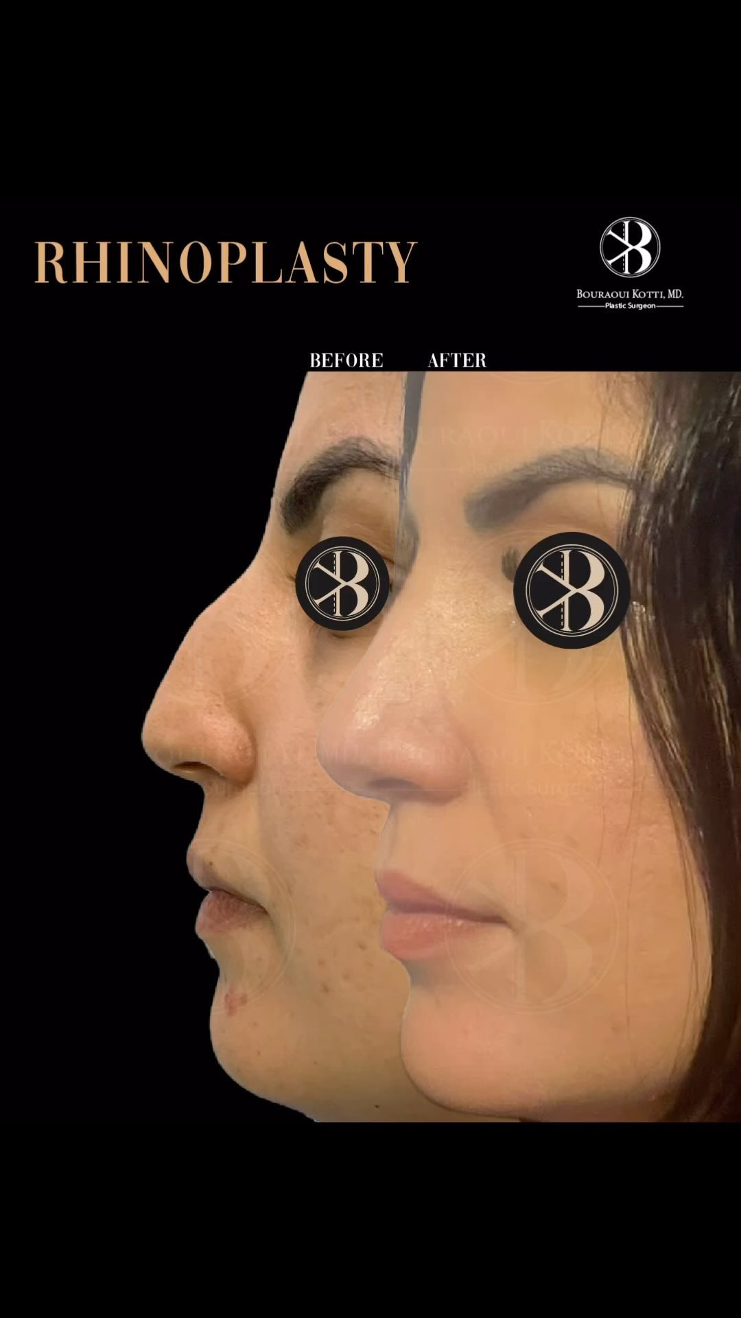 Rhinoplasty before and after clinical result