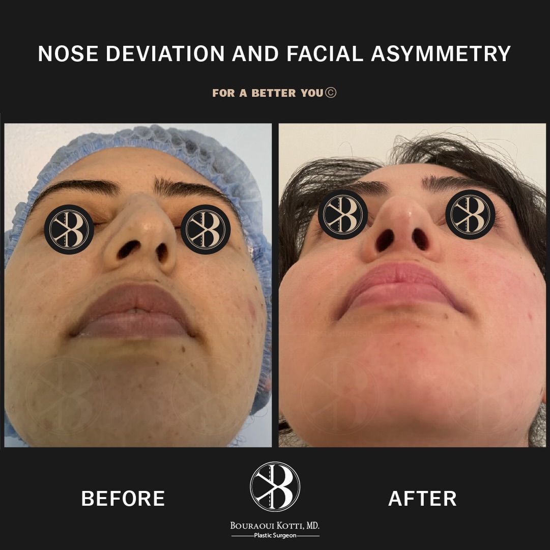 Rhinoplasty before and after clinical result